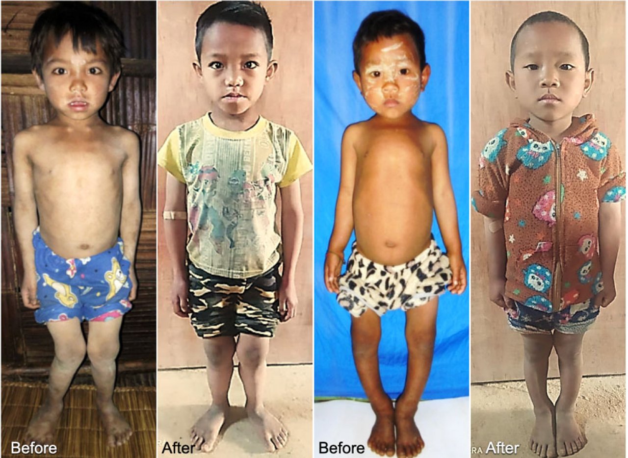 Rickets :: Medical Action Myanmar